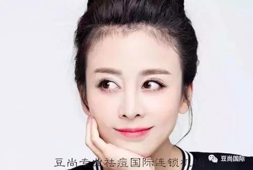 痘印没了，肌肤变白了，说说这是为啥？