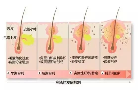 这个季节皮肤的痘痘为什么这样多？要怎样护理？