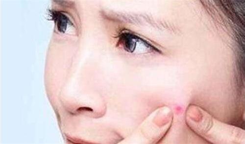 长痘痘不必惊慌，痘尚祛痘教你五个小妙招