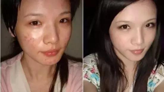 痤疮可以根治？别再受骗了！痘尚专业祛痘来告诉你原因