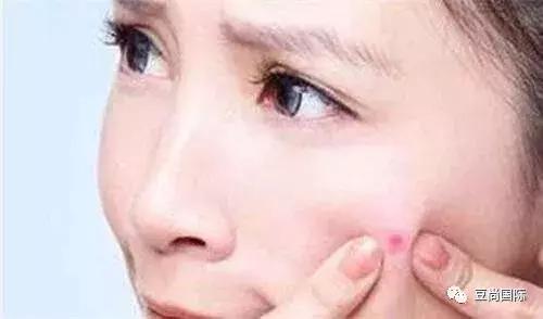 长痘痘不必惊慌，痘尚祛痘教你六个祛痘小妙招